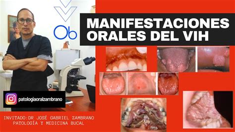 vih sexo oral|Cunnilingus et Sida : y a